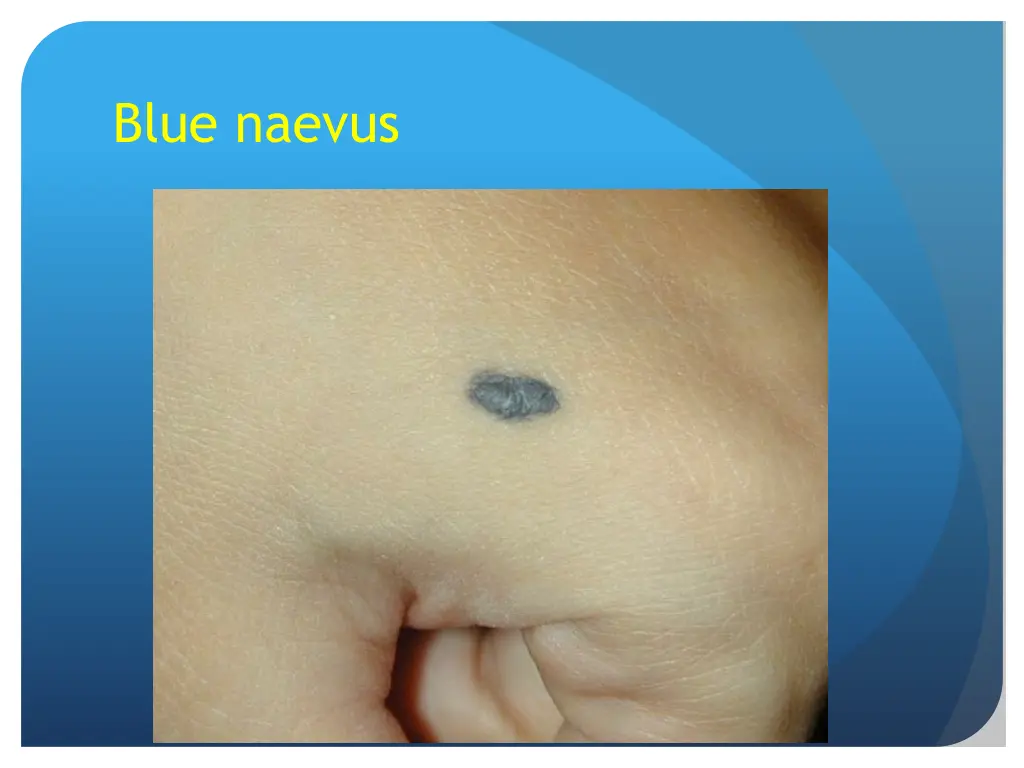 blue naevus
