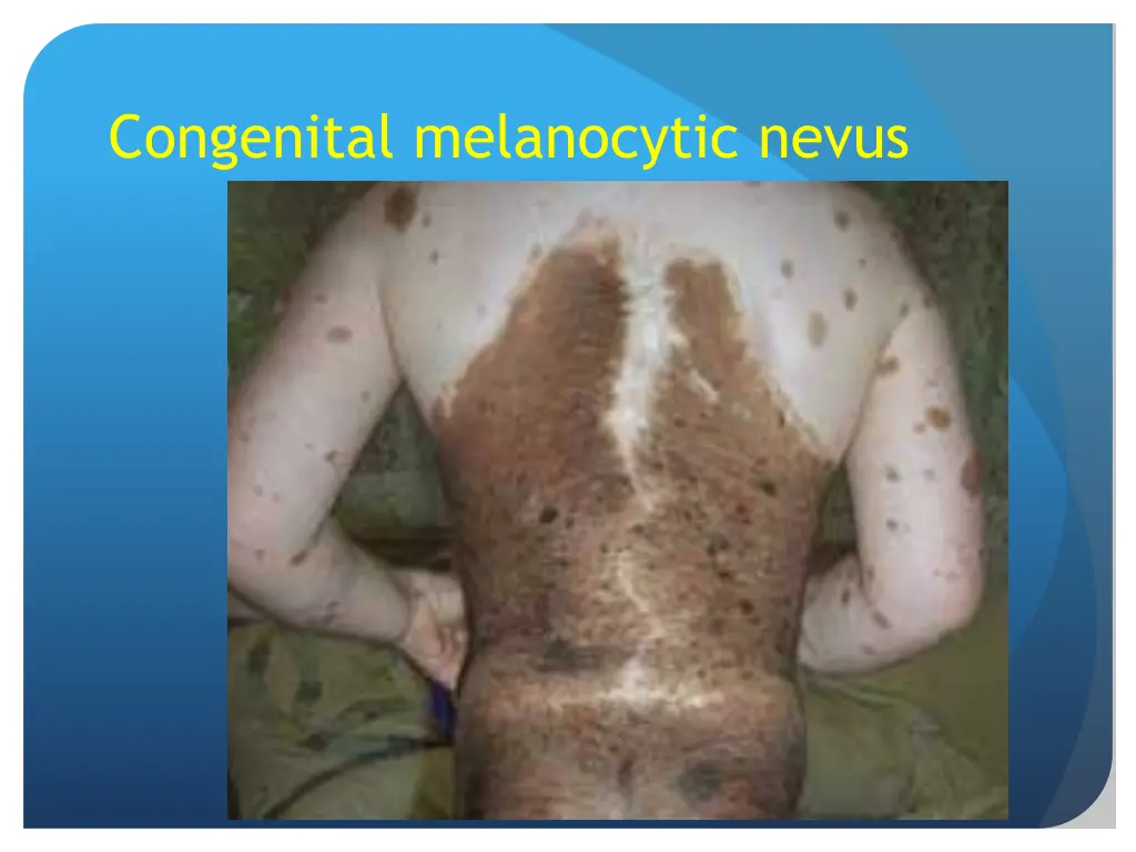 congenital melanocytic nevus