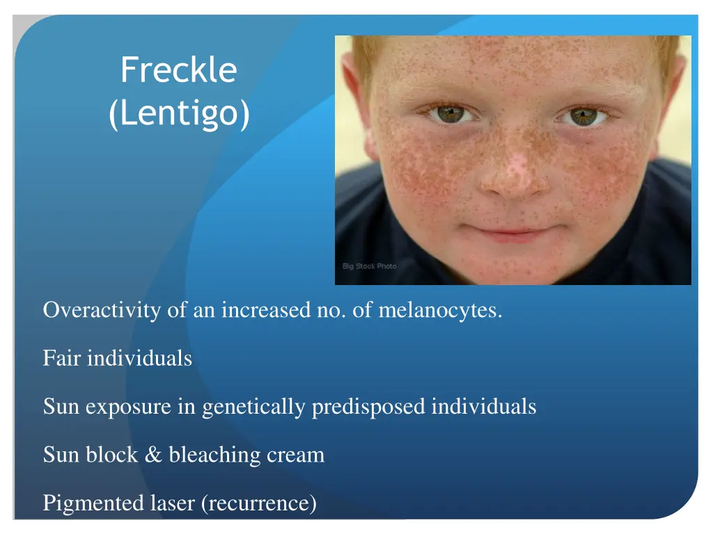 freckle lentigo