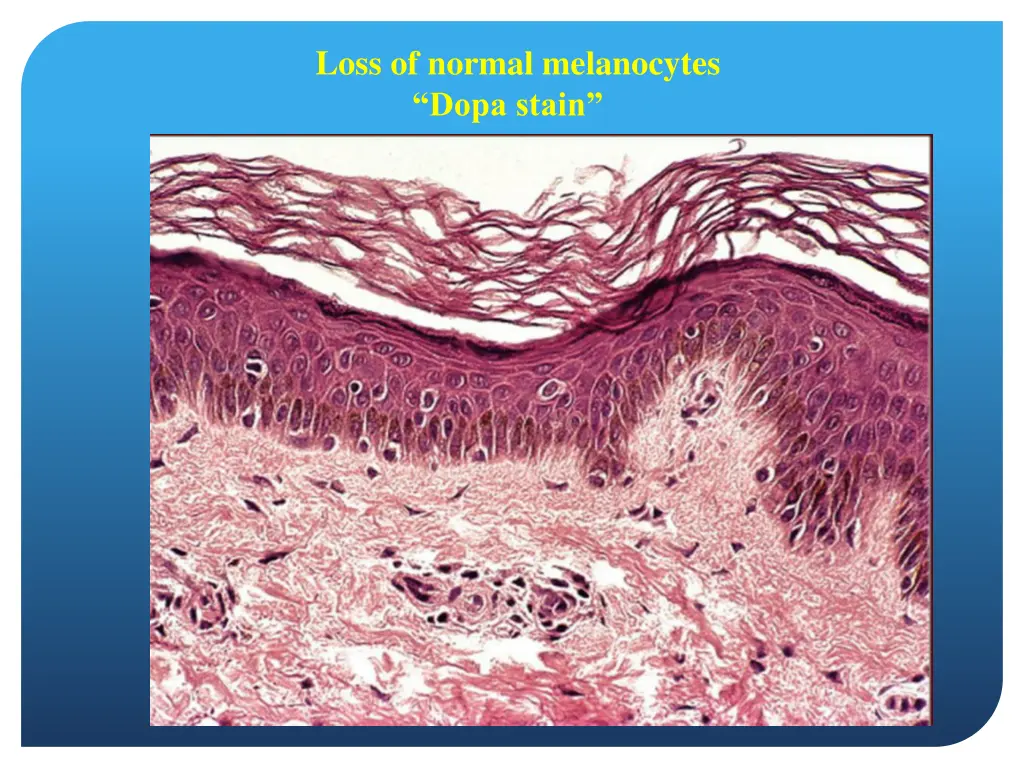 loss of normal melanocytes dopa stain