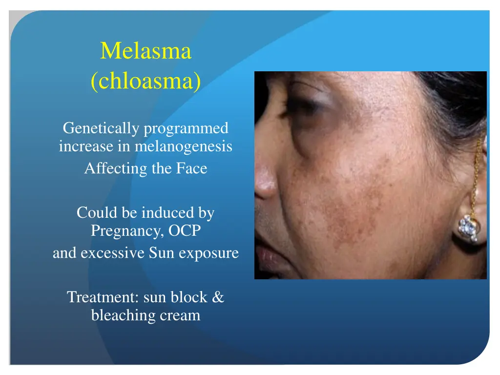 melasma chloasma
