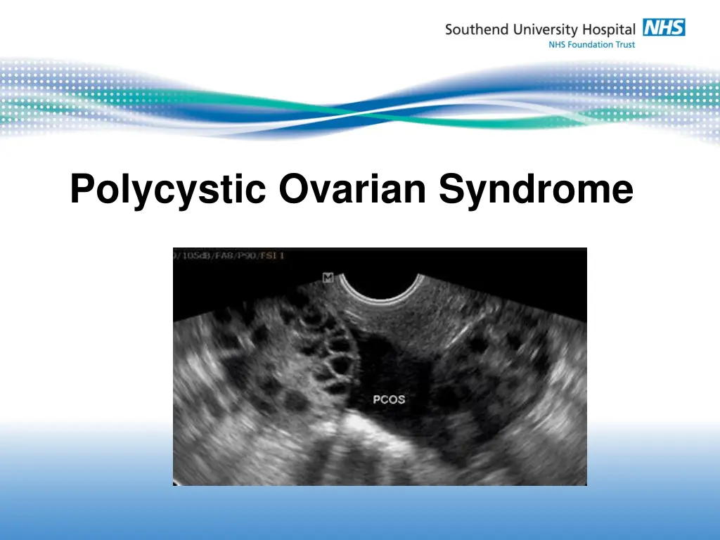 si polycystic ovarian syndrome