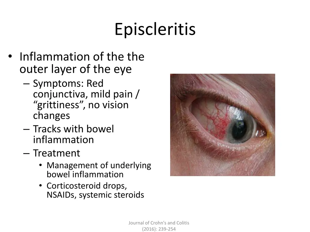 episcleritis