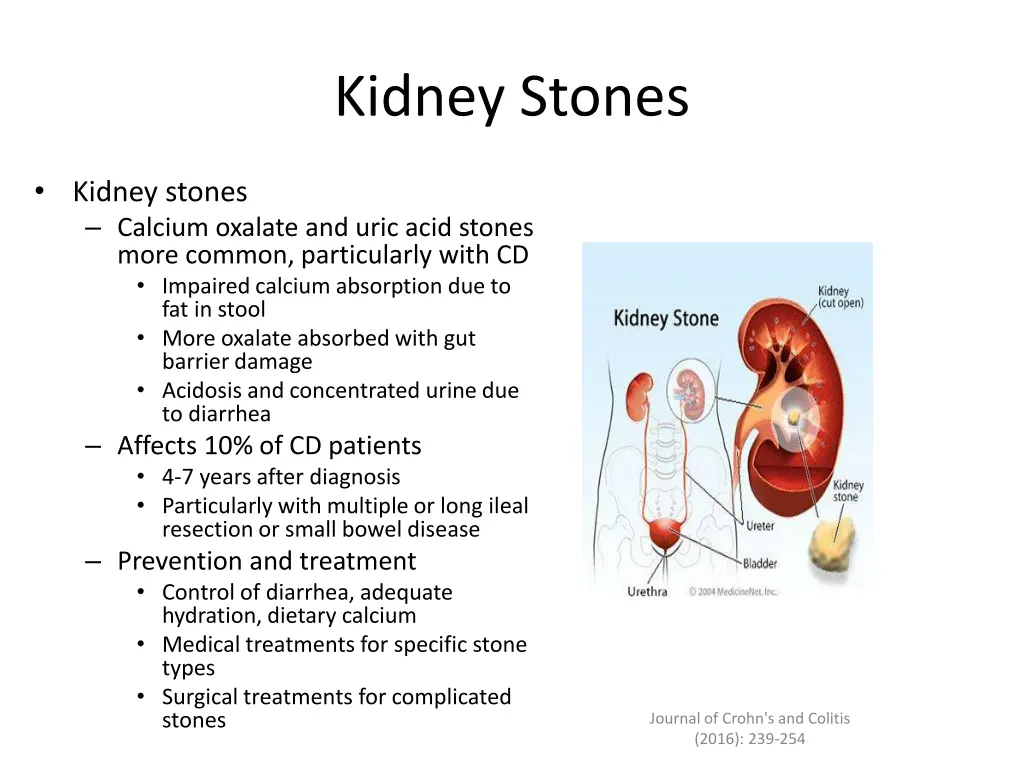 kidney stones