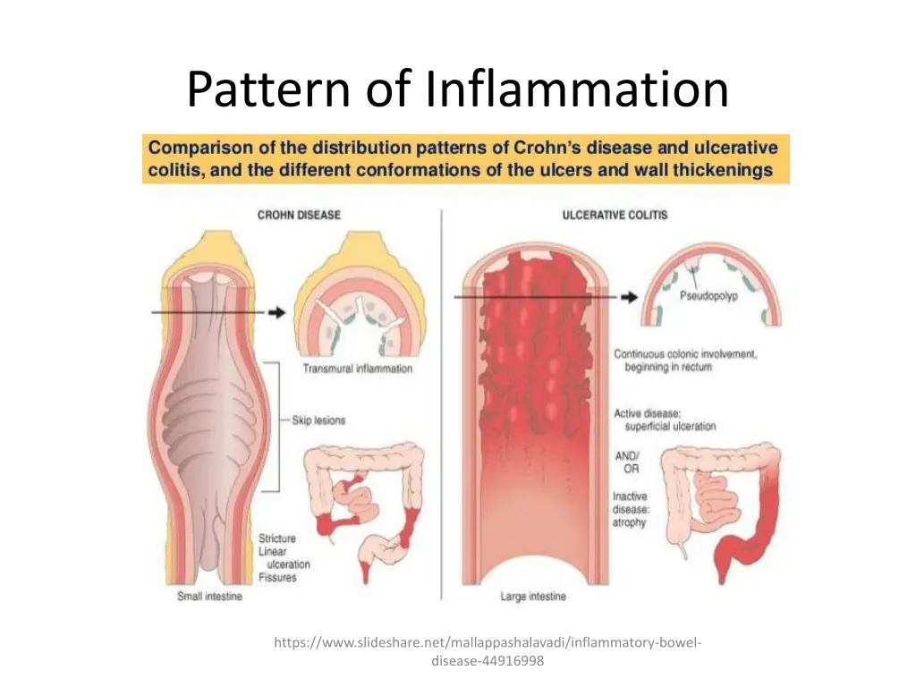pattern of inflammation
