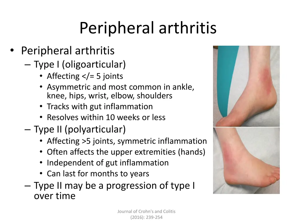peripheral arthritis