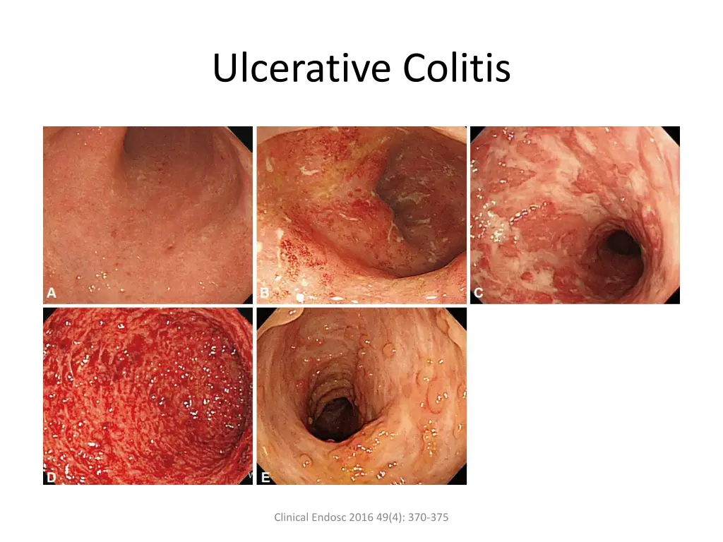 ulcerative colitis