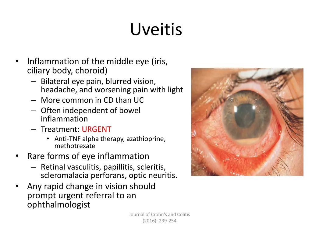 uveitis