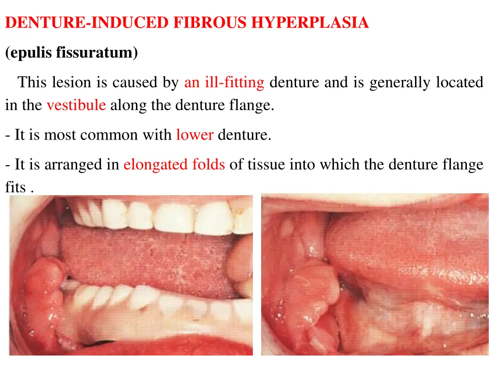 denture induced fibrous hyperplasia