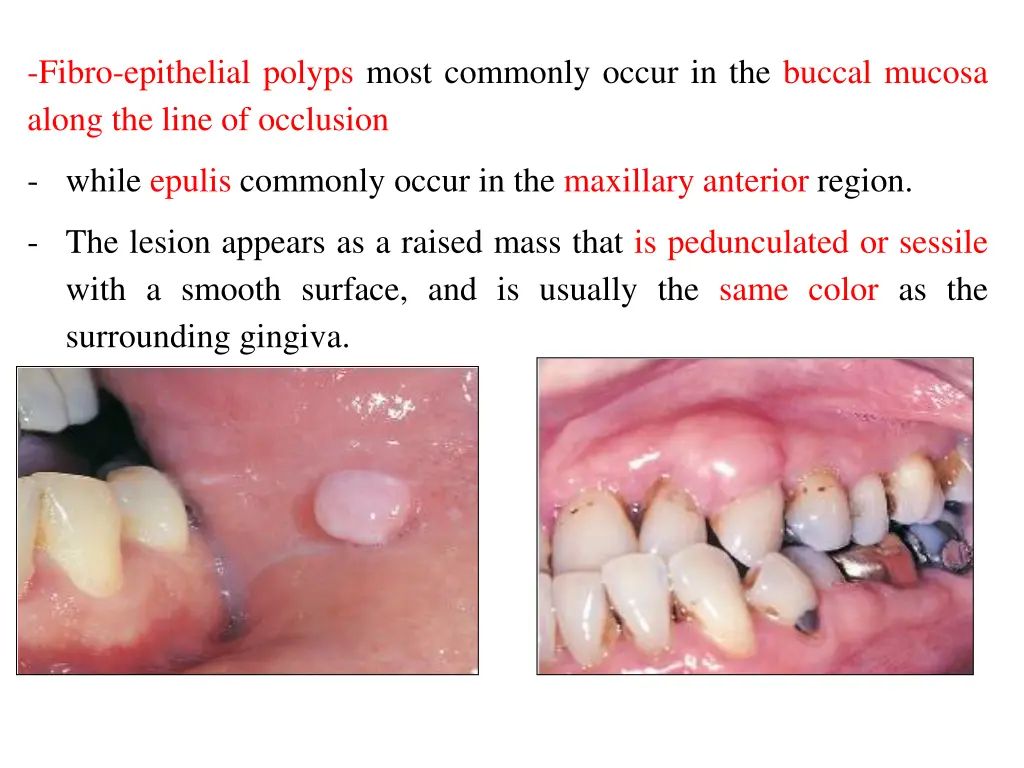 fibro epithelial polyps most commonly occur