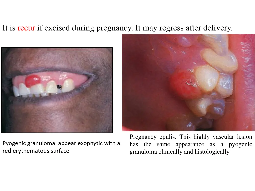 it is recur if excised during pregnancy