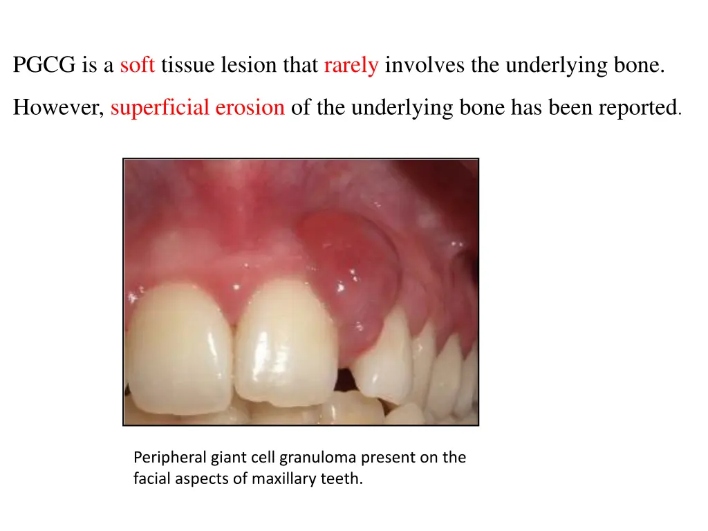 pgcg is a soft tissue lesion that rarely involves