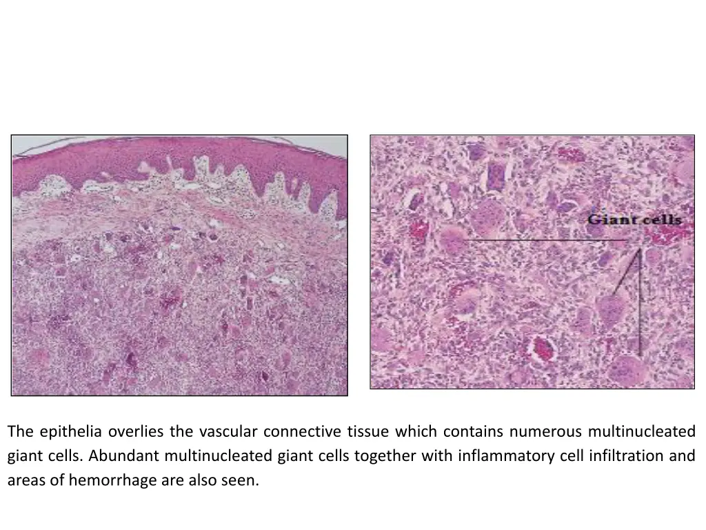 the epithelia overlies the vascular connective
