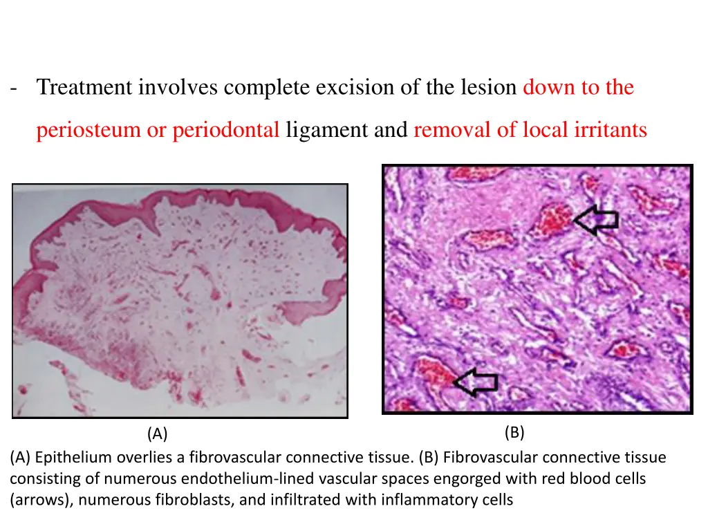 treatment involves complete excision
