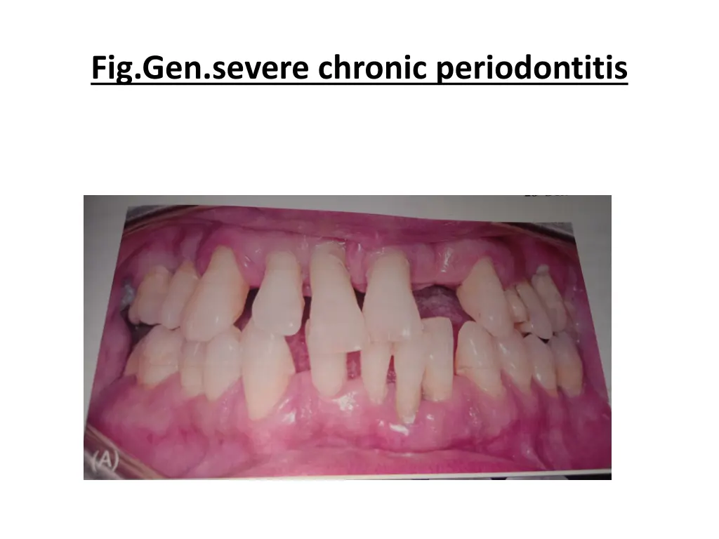 fig gen severe chronic periodontitis