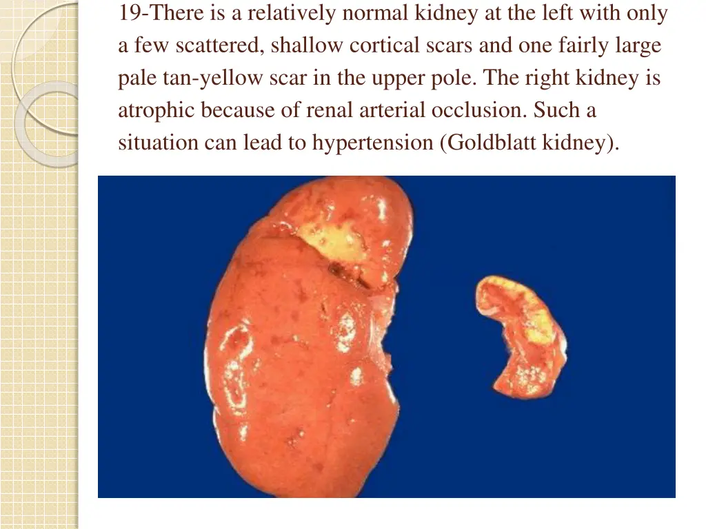 19 there is a relatively normal kidney
