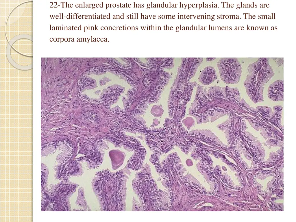 22 the enlarged prostate has glandular