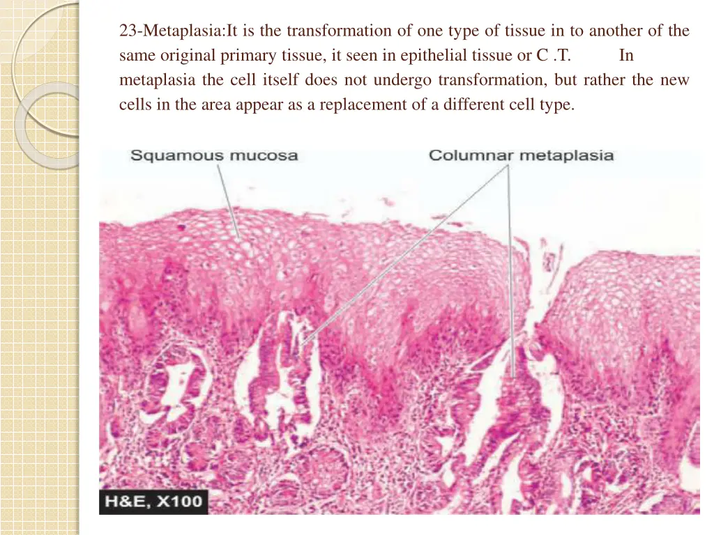 23 metaplasia it is the transformation