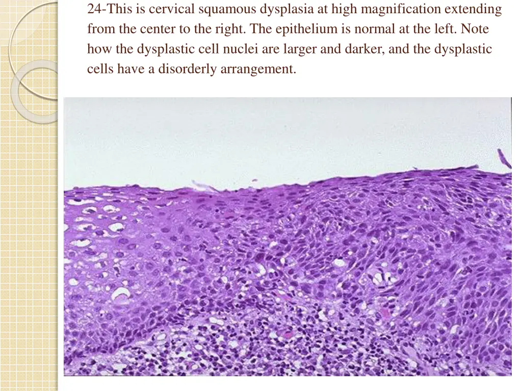 24 this is cervical squamous dysplasia at high