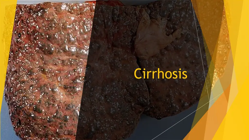 cirrhosis