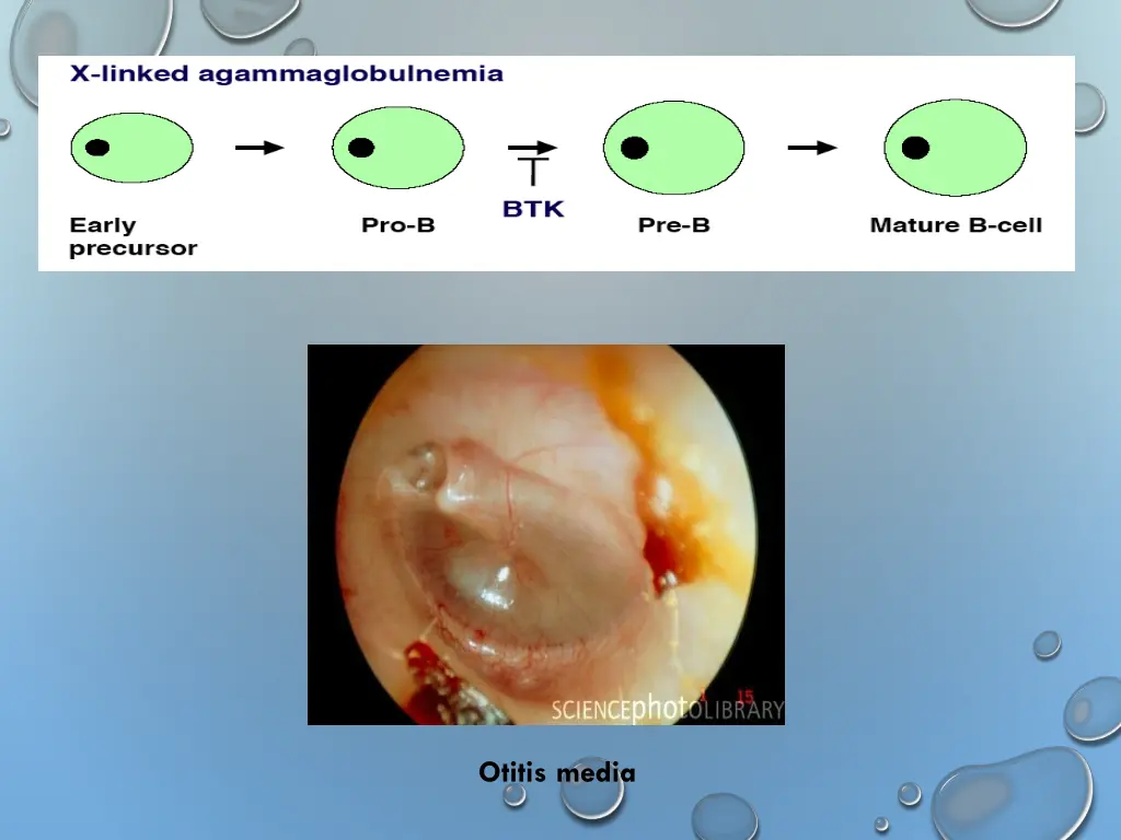 otitis media