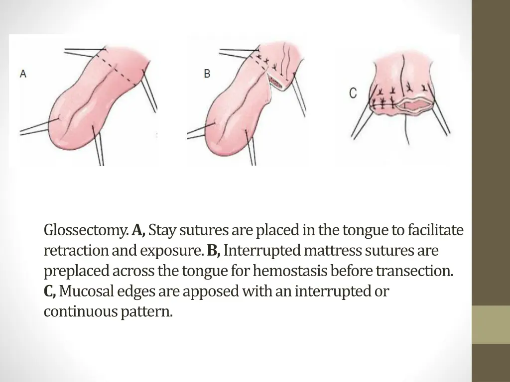 glossectomy a stay sutures are placed