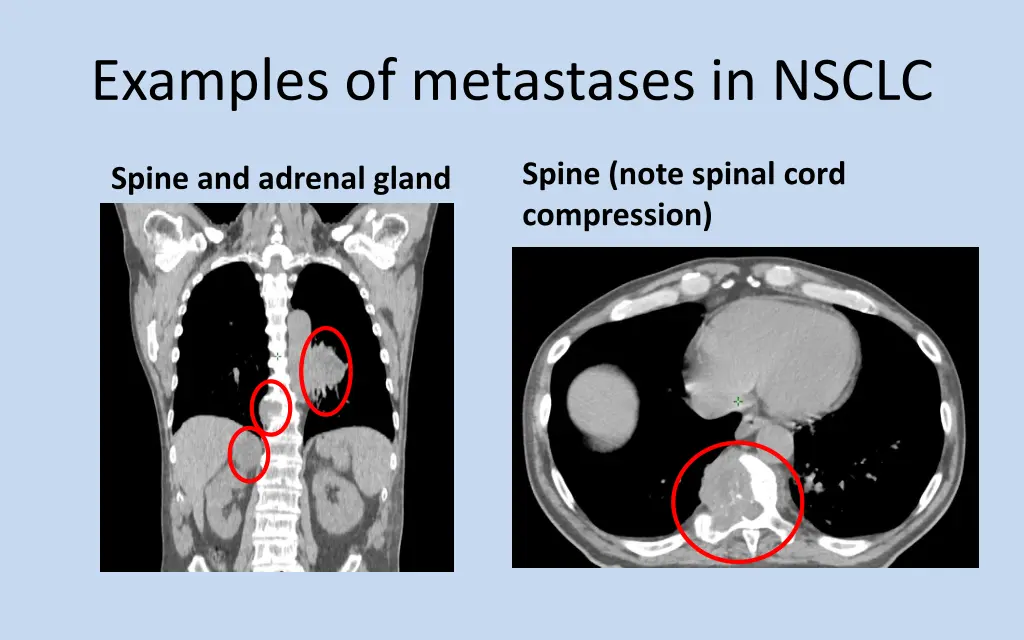 examples of metastases in nsclc