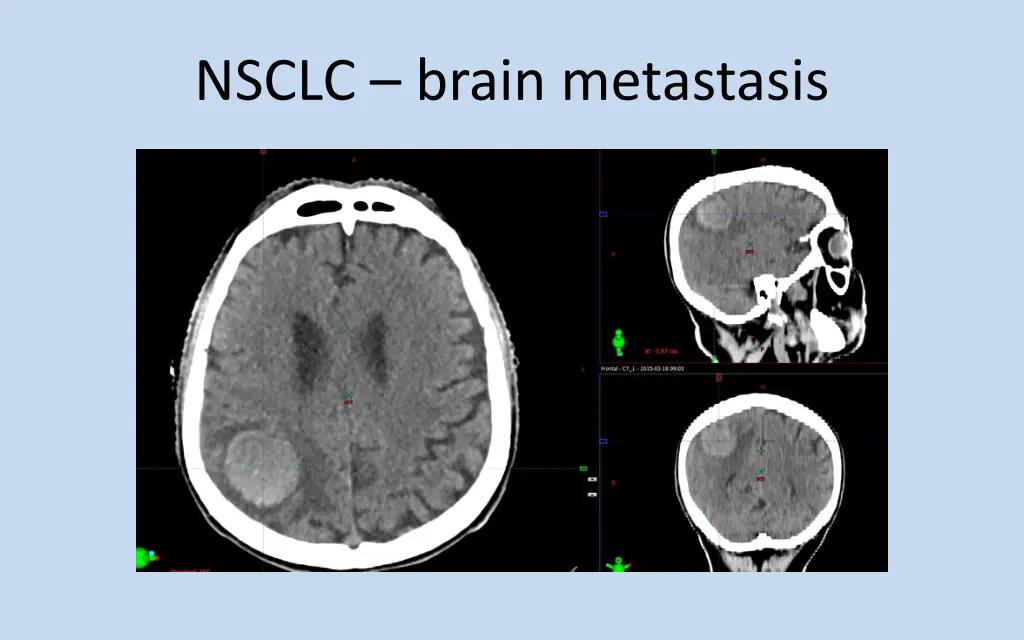 nsclc brain metastasis