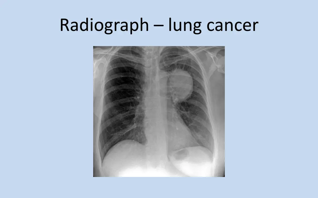 radiograph lung cancer