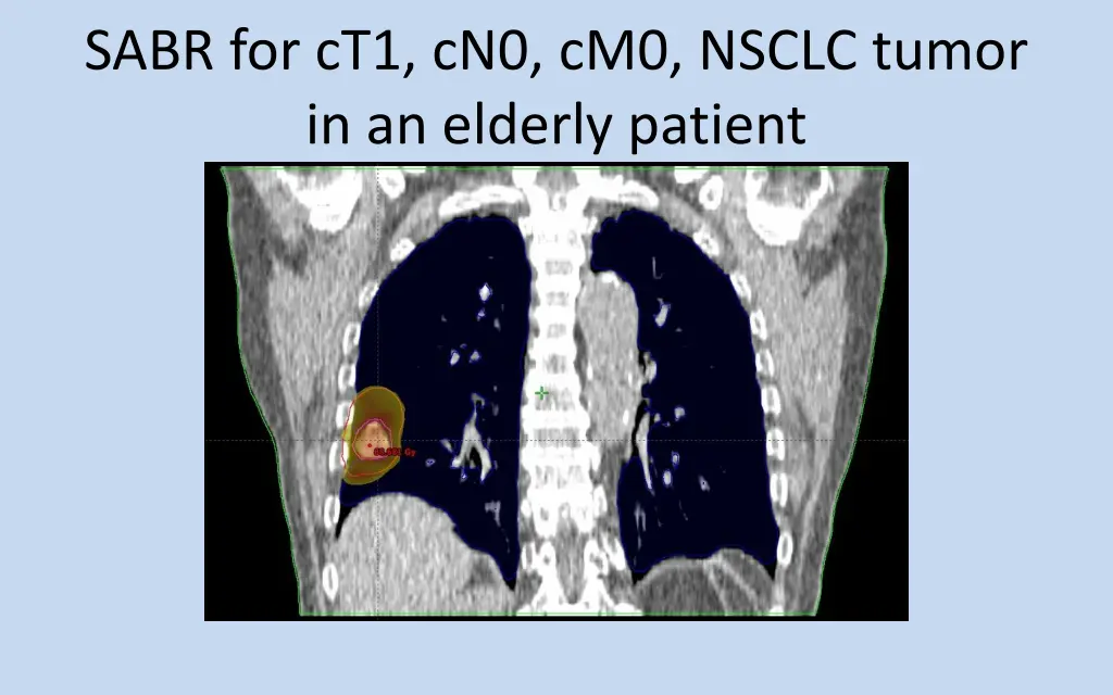 sabr for ct1 cn0 cm0 nsclc tumor in an elderly