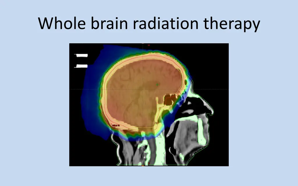 whole brain radiation therapy