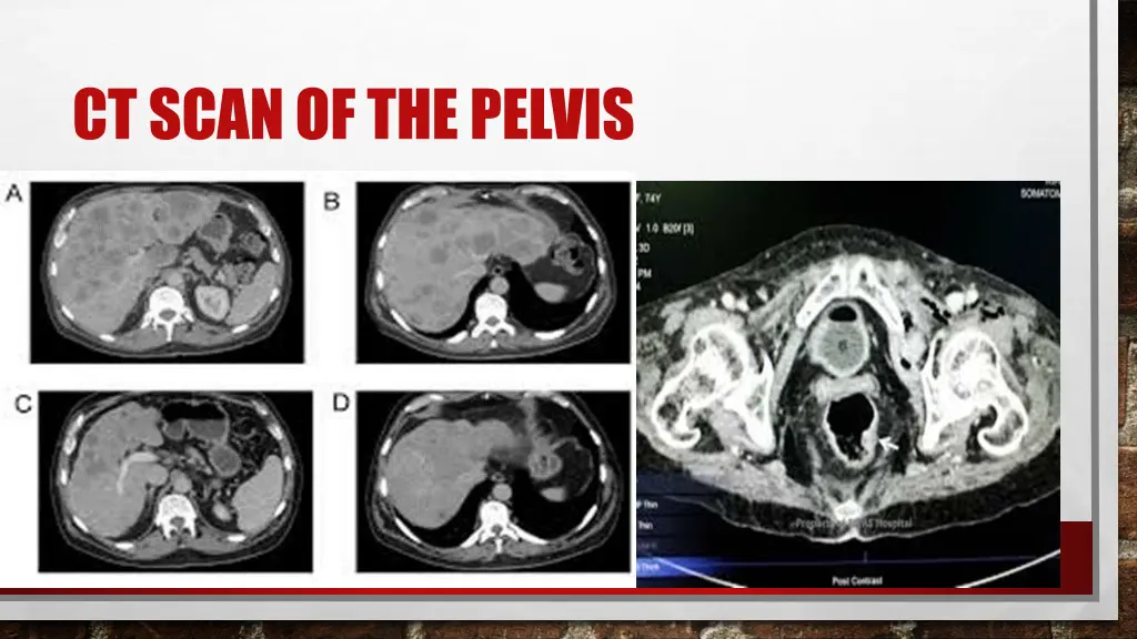 ct scan of the pelvis