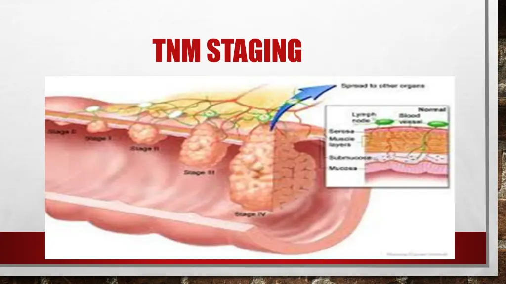 tnmstaging