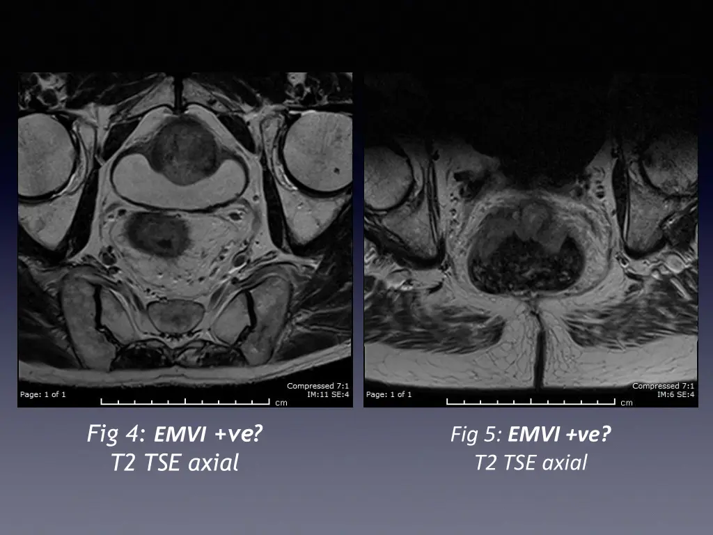 fig 4 emvi ve t2 tse axial