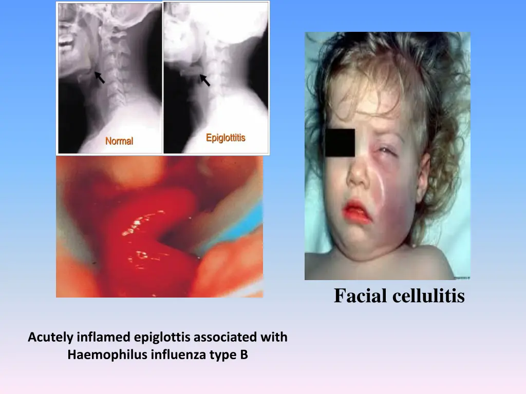 facial cellulitis
