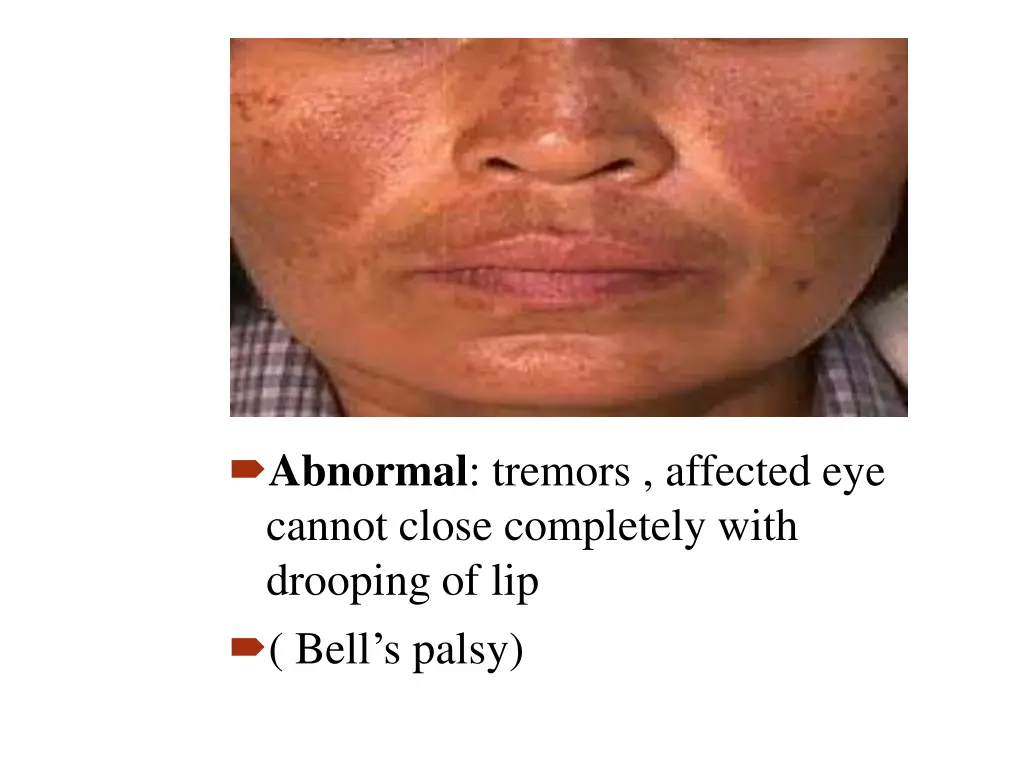 abnormal tremors affected eye cannot close