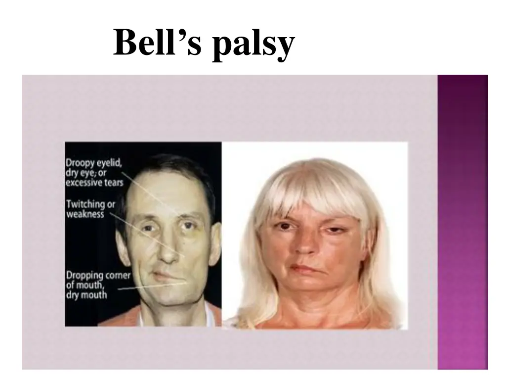bell s palsy
