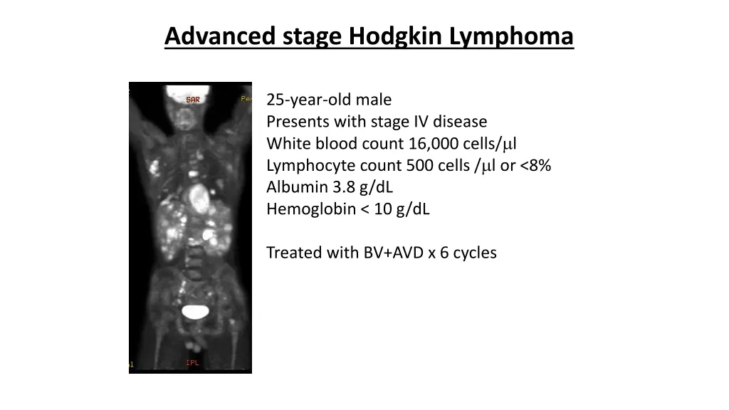 advanced stage hodgkin lymphoma
