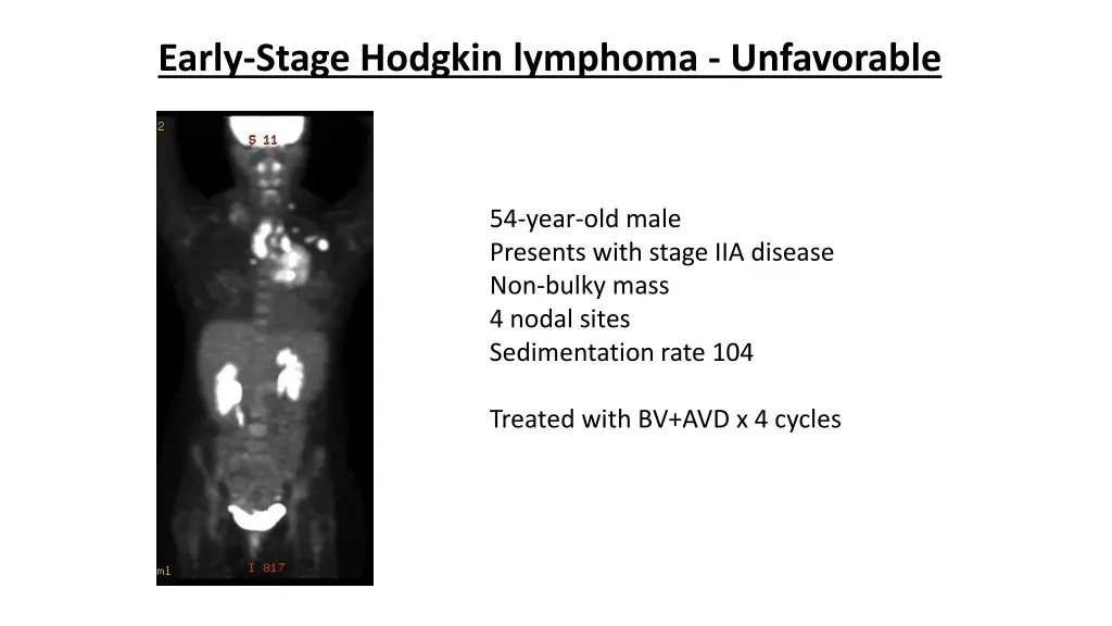 early stage hodgkin lymphoma unfavorable