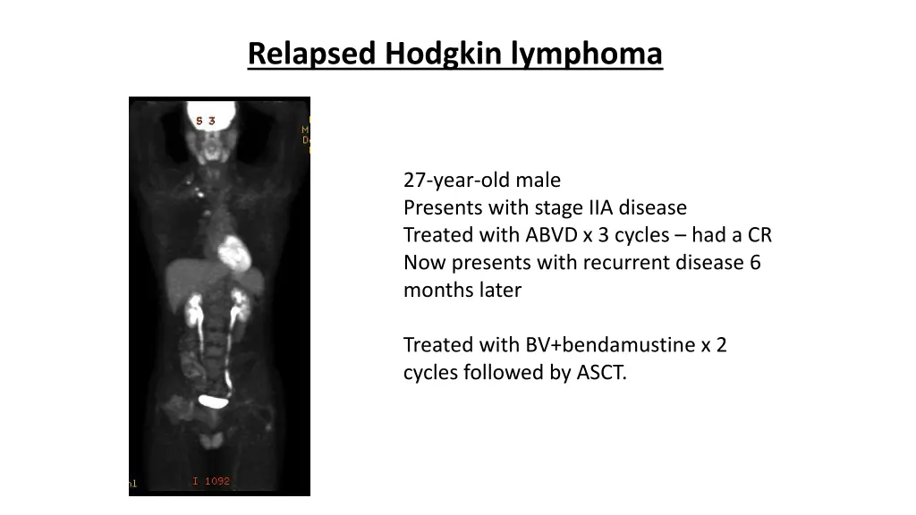 relapsed hodgkin lymphoma