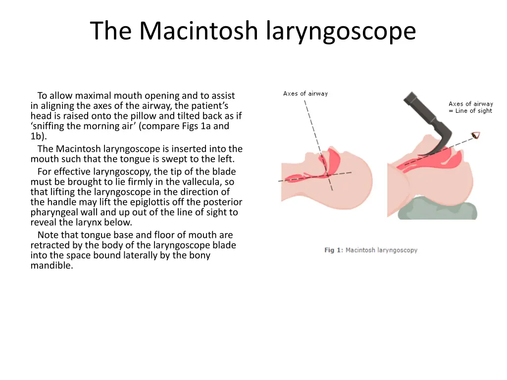 the macintosh laryngoscope