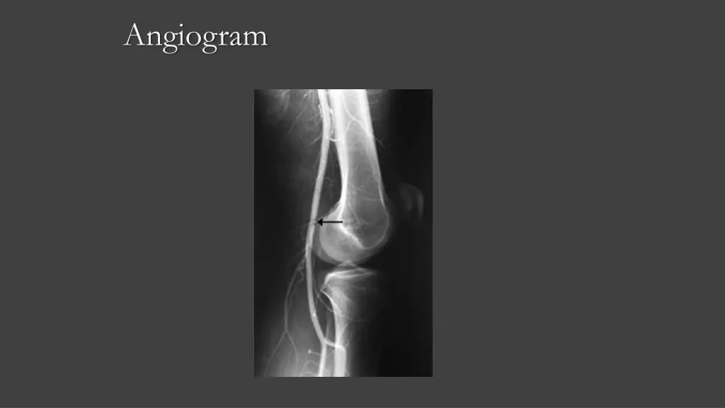 angiogram