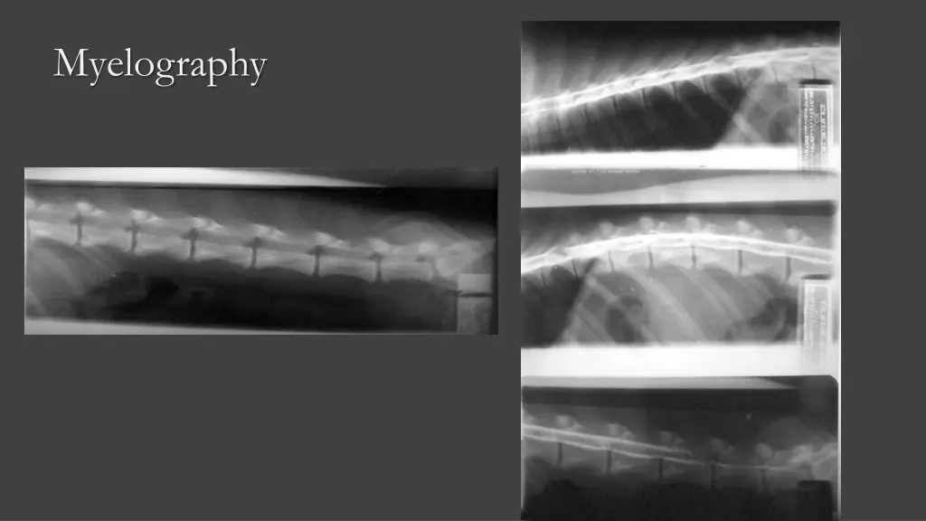 myelography