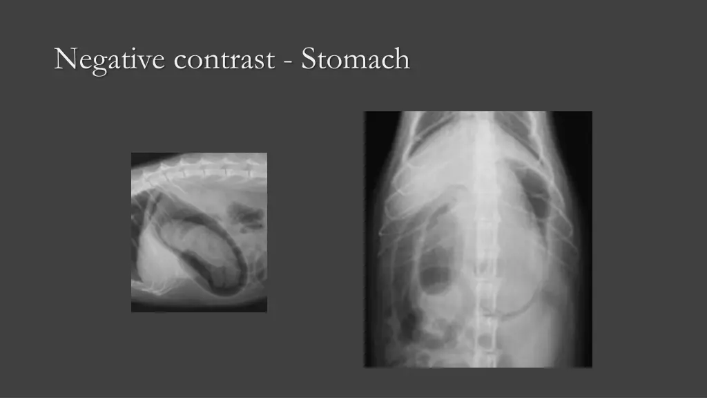 negative contrast stomach