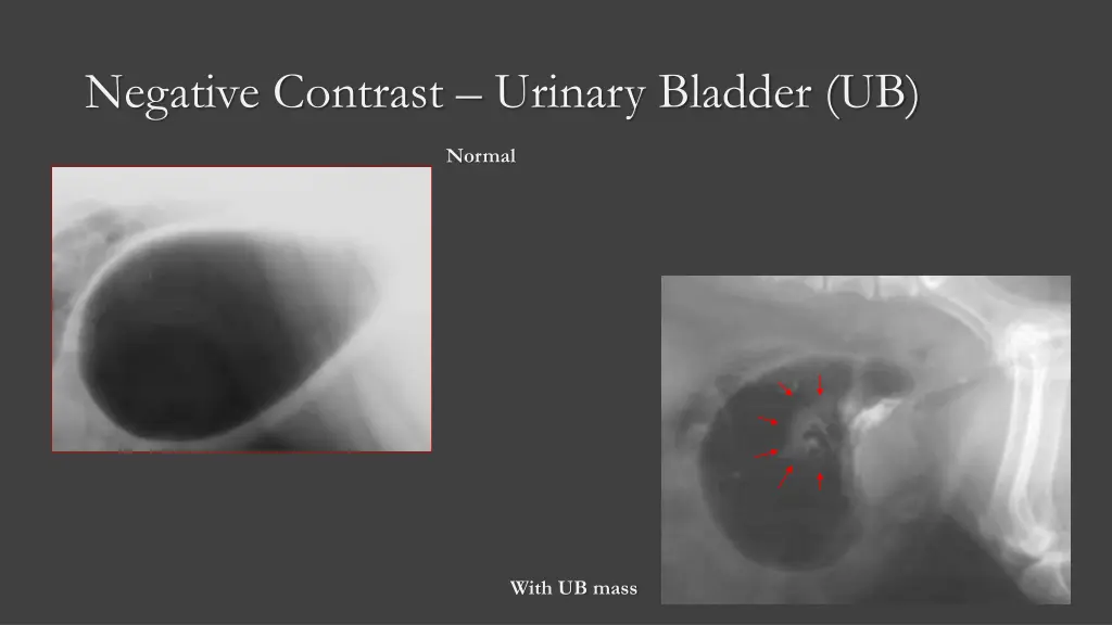 negative contrast urinary bladder ub