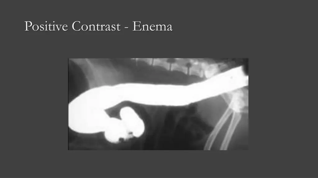 positive contrast enema 1