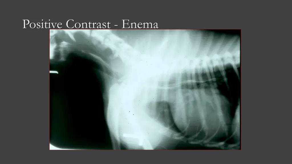 positive contrast enema