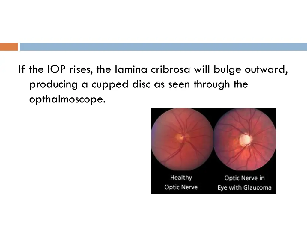 if the iop rises the lamina cribrosa will bulge