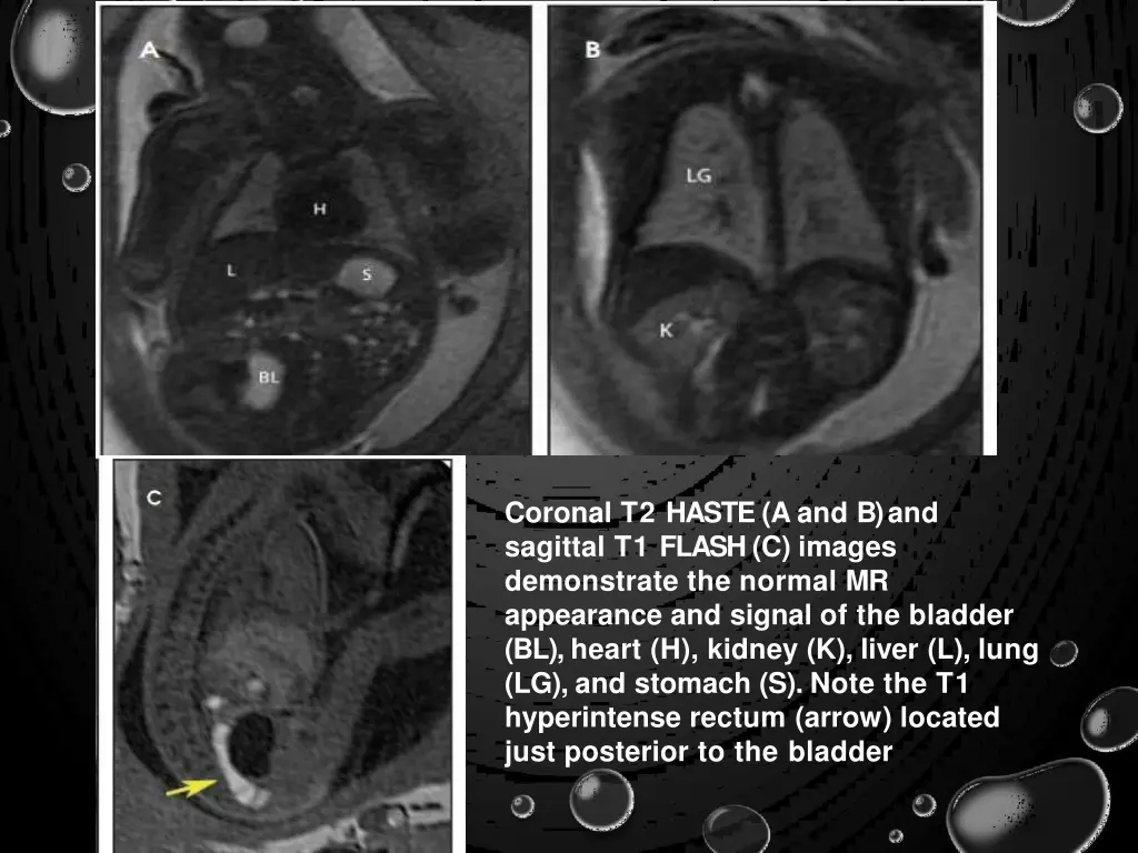 coronal t2 haste a and b and sagittal t1 flash