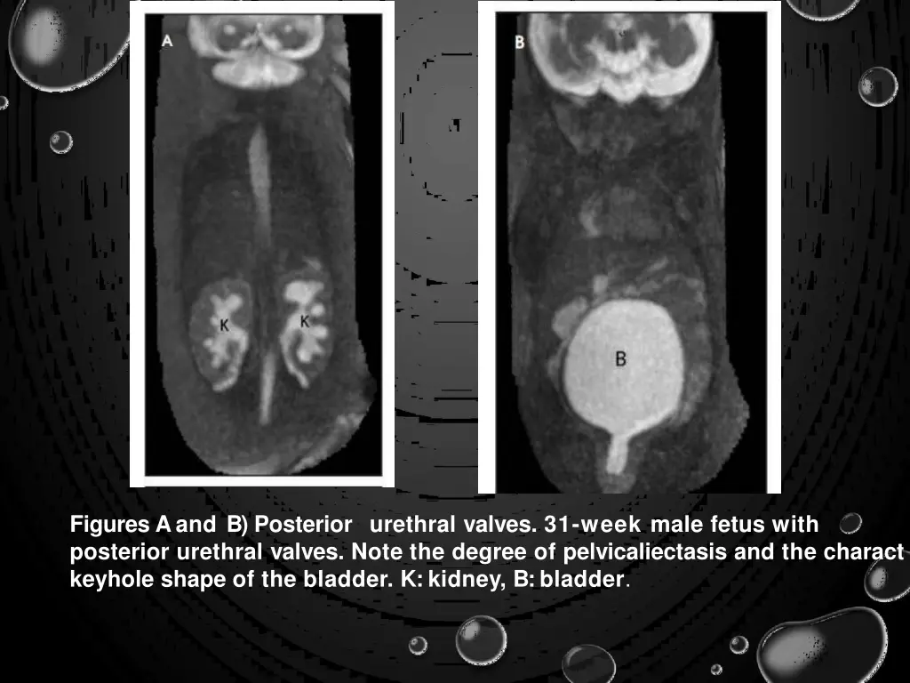 figures a and b posterior urethral valves 31 week